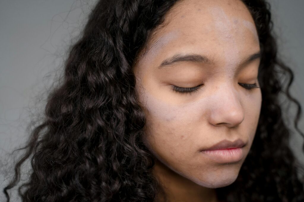 acne treatment
