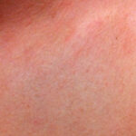 Heat rash