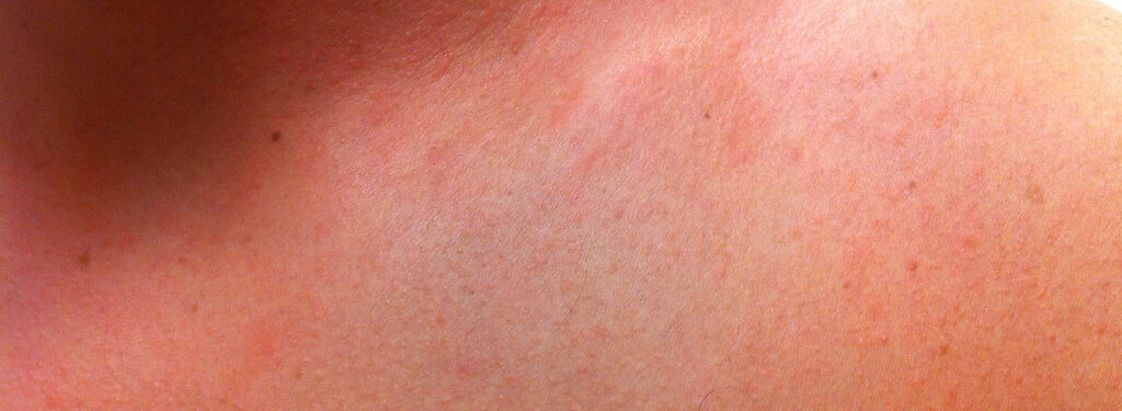 Heat rash